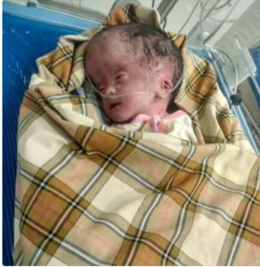 Nur Aqidah Bayi Mengidap Hidrosefalus Butuh Uluran Tangan