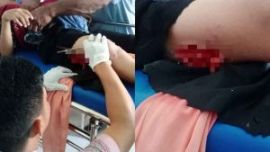 Pengunjung Danau Fotu di Buteng Diterkam Buaya, Luka Menganga di Paha Kanan dan Terima 83 Jahitan 